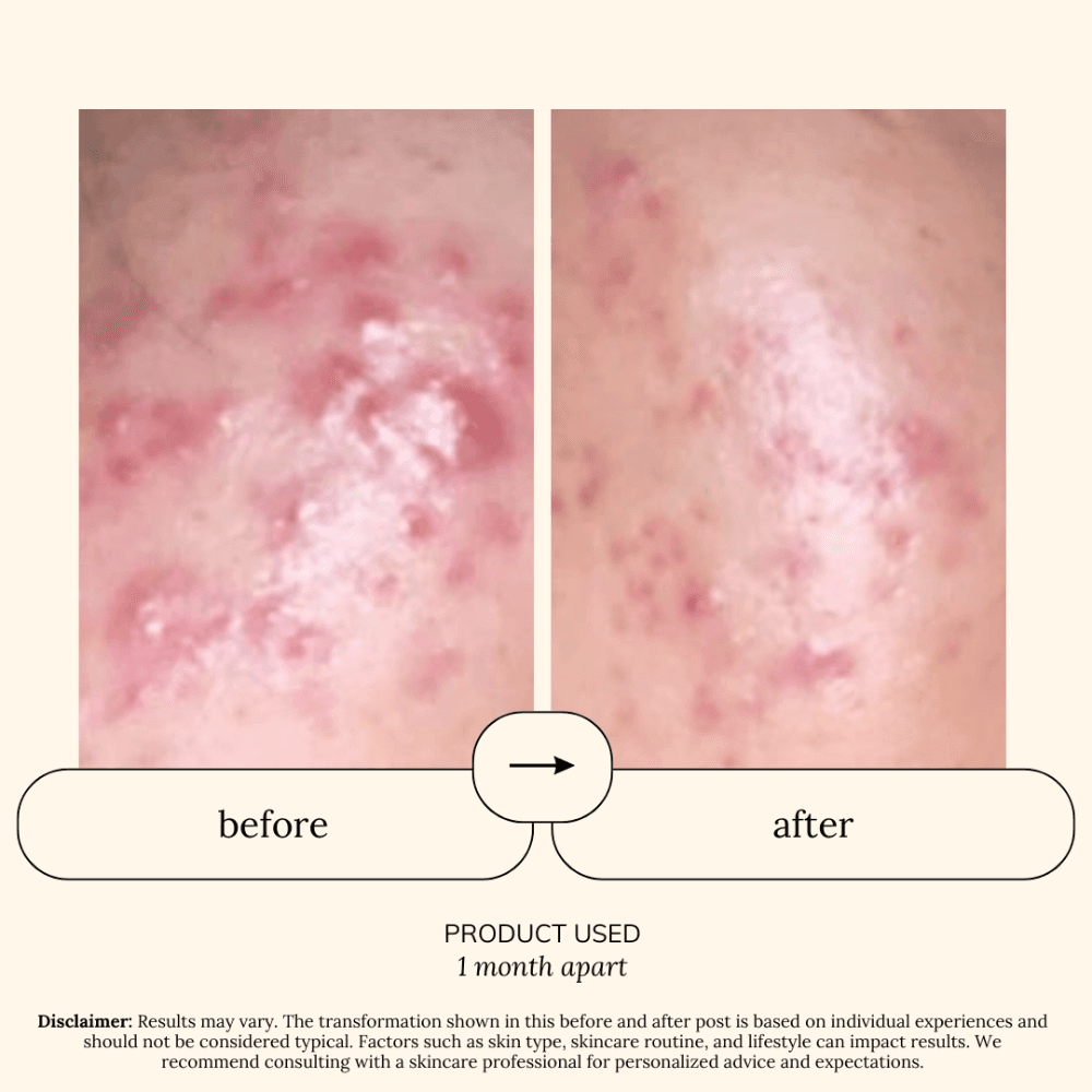 Soul Apothecary Hydra Gentle Spot Care | Rice Extract + 2% Salicylic Acid Blemish Treatment thumbnail 5